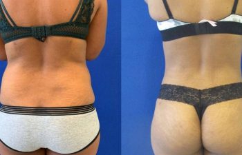 Female Patient Before & After Liposuction