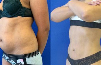 Female Patient Before & After Liposuction