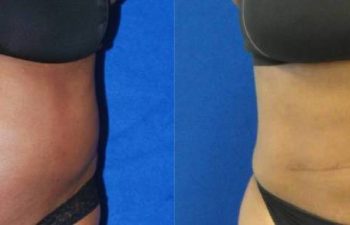 Female Patient Before & After Liposuction