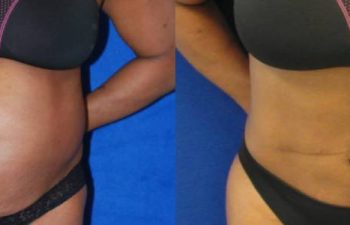 Female Patient Before & After Liposuction