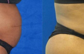 Female Patient Before & After Liposuction