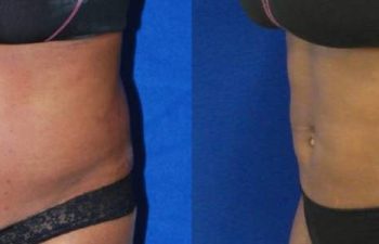 Female Patient Before & After Liposuction