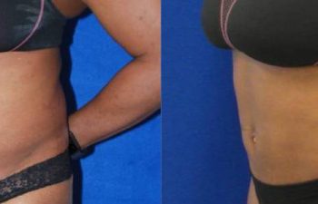 Female Patient Before & After Liposuction