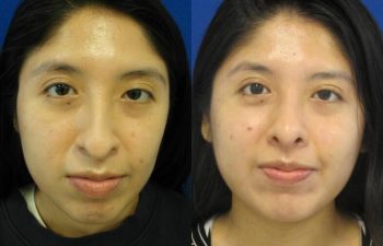 Female Patient Before & After Rhinoplasty