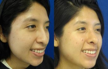 Female Patient Before & After Rhinoplasty