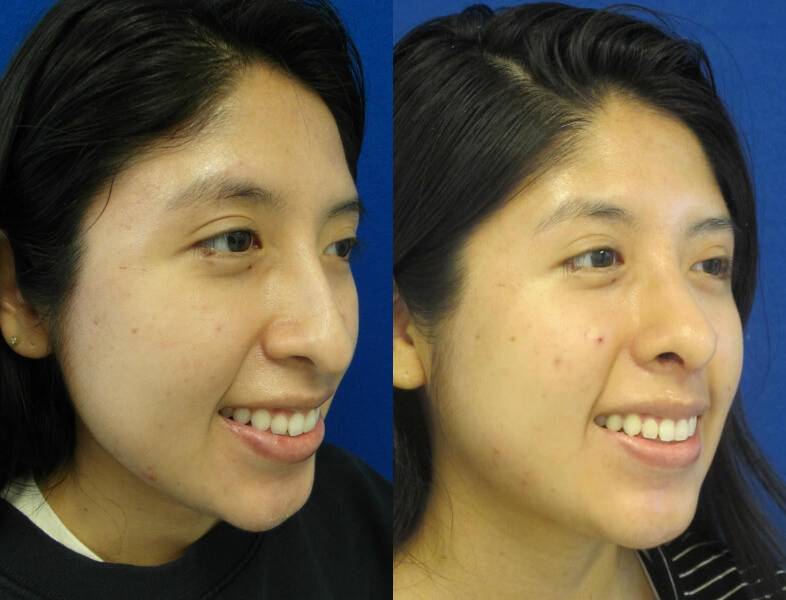 Female Patient Before & After Rhinoplasty