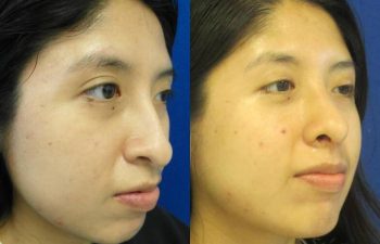 Female Patient Before & After Rhinoplasty