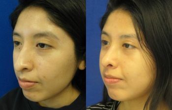 Female Patient Before & After Rhinoplasty