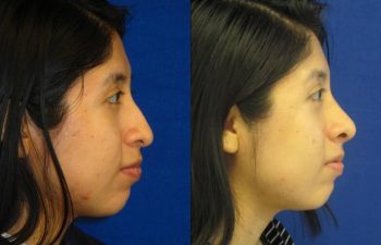 Female Patient Before & After Rhinoplasty