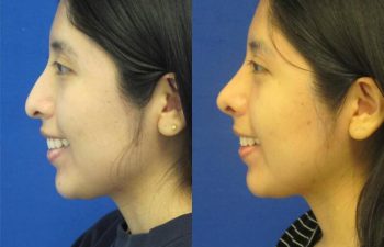 Female Patient Before & After Rhinoplasty