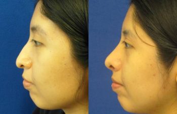 Female Patient Before & After Rhinoplasty