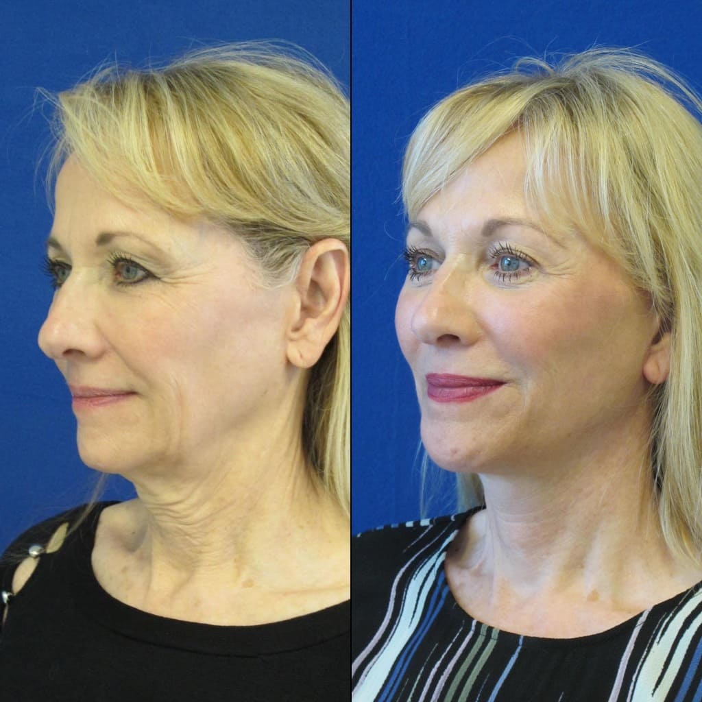 Female Patient Before & After FaceLift