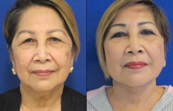 Female Patient Before & After Mini FaceLift