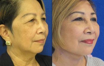 Female Patient Before & After Mini FaceLift