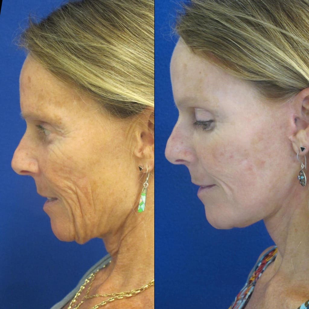 Female Patient Before & After FaceLift