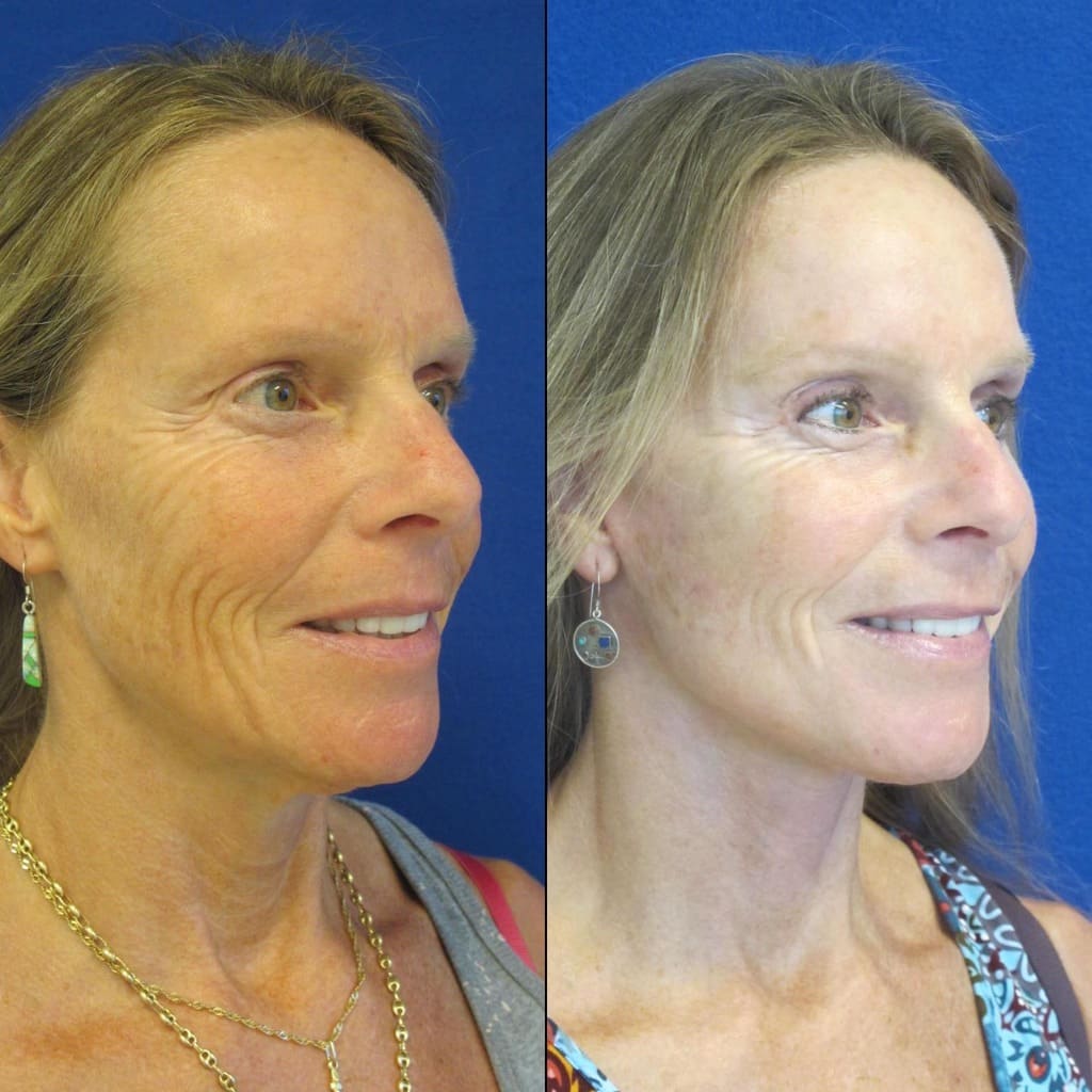 Female Patient Before & After FaceLift