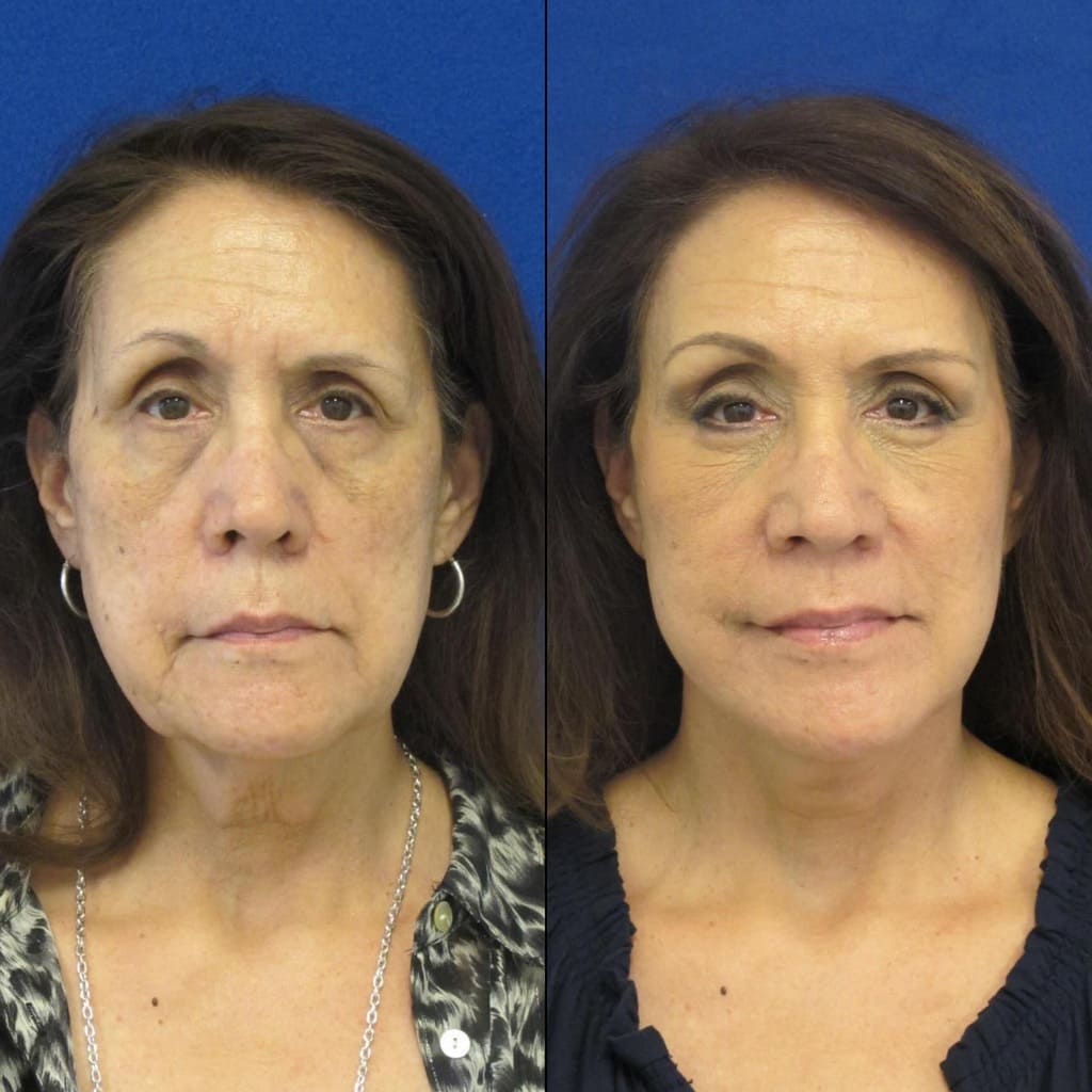 Female Patient Before & After FaceLift