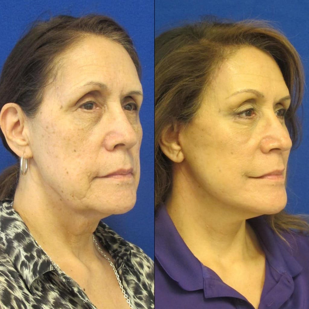 Female Patient Before & After FaceLift