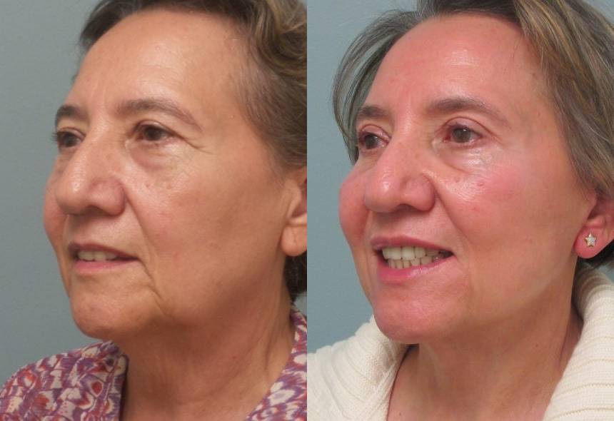 Female Patient Before & After FaceLift