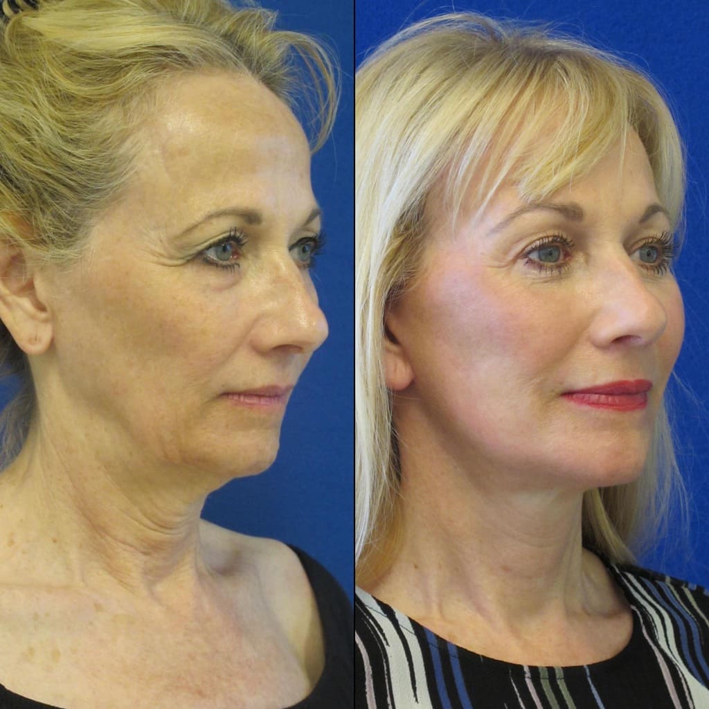 Female Patient Before & After FaceLift