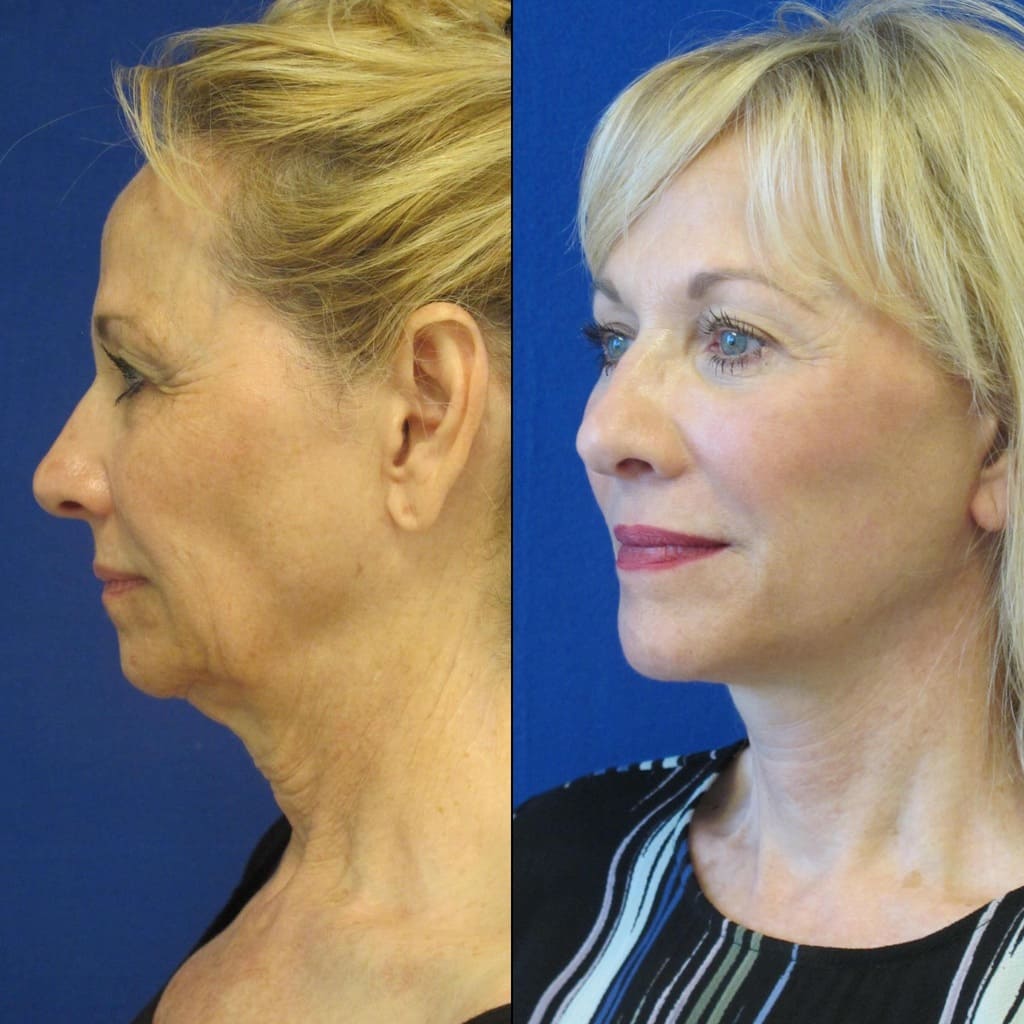 Female Patient Before & After FaceLift