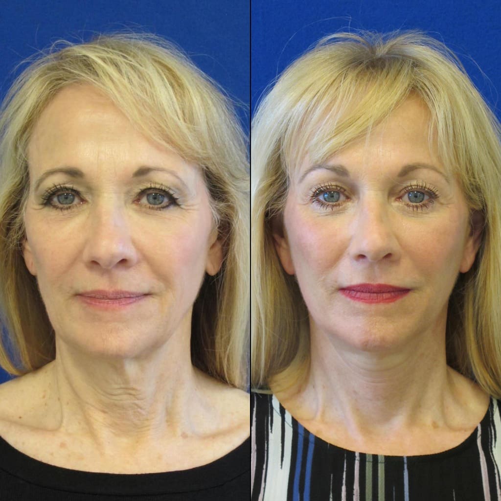 Female Patient Before & After FaceLift