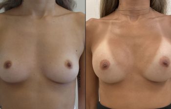 Female Patient Before & After Breast Augmentation