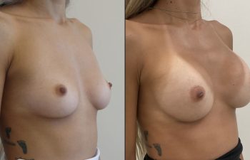 Female Patient Before & After Breast Augmentation