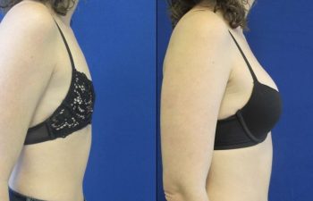 Female Patient Before & After Breast Augmentation