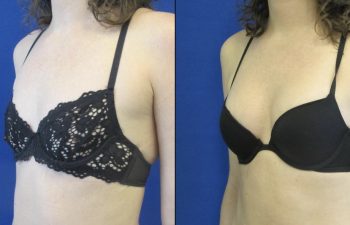 Female Patient Before & After Breast Augmentation