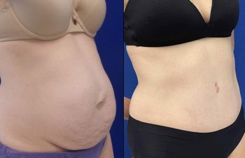 Female Patient Before & After Tummy Tuck