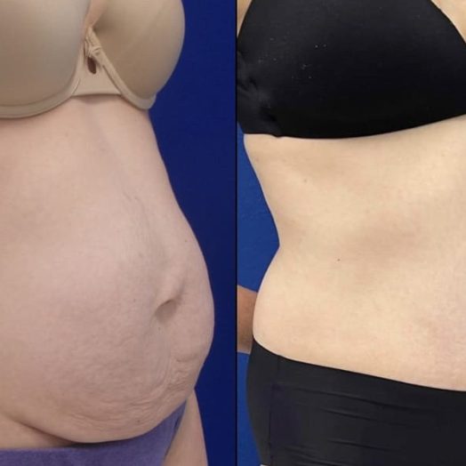 Female Patient Before & After Tummy Tuck