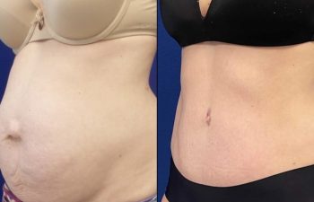 Female Patient Before & After Tummy Tuck