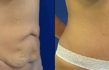 Female Patient Before & After Tummy Tuck