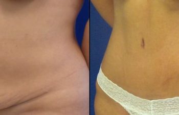 Female Patient Before & After Tummy Tuck