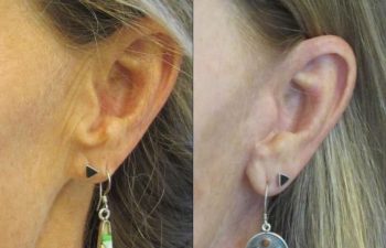 Female Patient Before & After FaceLift