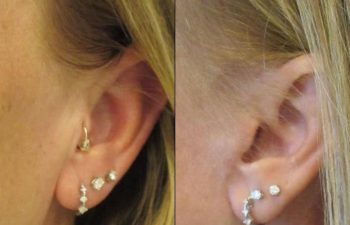 Female Patient Before & After FaceLift