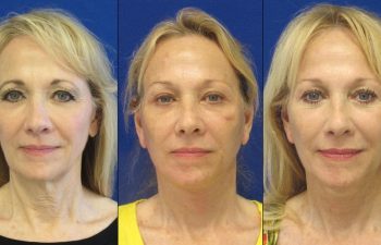 Female Patient Before & After FaceLift