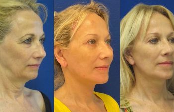 Female Patient Before & After FaceLift
