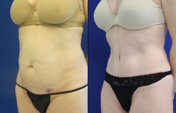 50 year-old patient before and after abdominoplasty, flanks liposuction and hernia repair