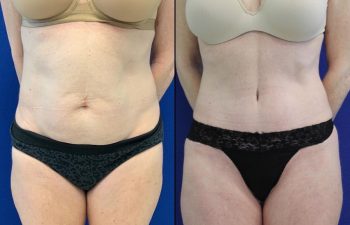 50 year-old patient before and after abdominoplasty, flanks liposuction and hernia repair