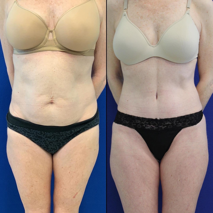 50 year-old patient before and after abdominoplasty, flanks liposuction and hernia repair