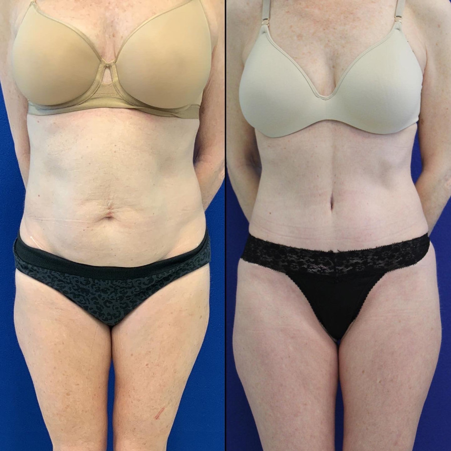 Reverse Tummy Tuck Before and After - Plano Plastic Surgery