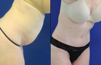 50 year-old patient before and after abdominoplasty, flanks liposuction and hernia repair