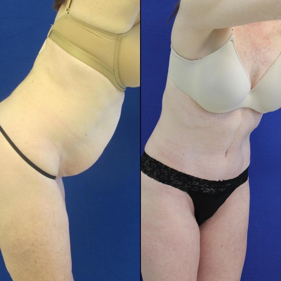 50 year-old patient before and after abdominoplasty, flanks liposuction and hernia repair