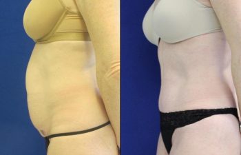 50 year-old patient before and after abdominoplasty, flanks liposuction and hernia repair