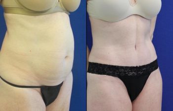 50 year-old patient before and after abdominoplasty, flanks liposuction and hernia repair