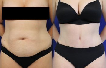 Tummy Tuck/Abdominoplasty Before & After Photos