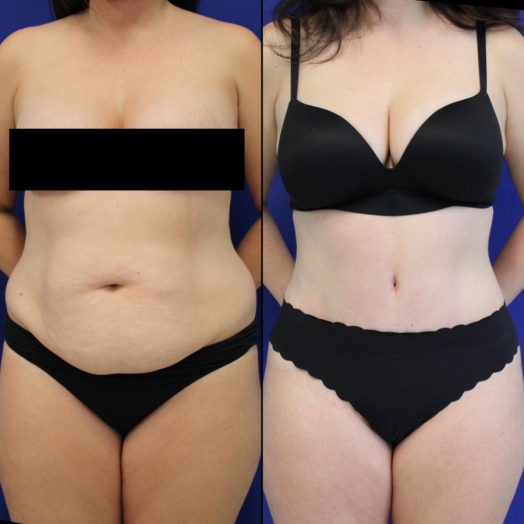 Tummy Tuck/Abdominoplasty Before & After Photos