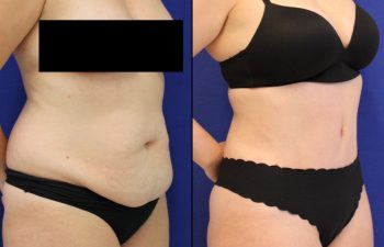 Tummy Tuck / Abdominoplasty Before & After Photos